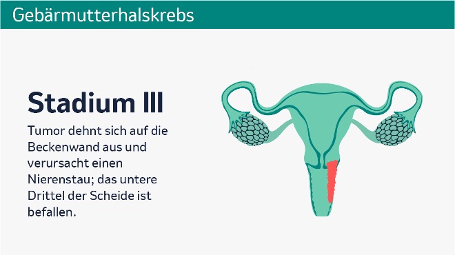 Gebärmutterhalskrebs - MSD Gesundheit