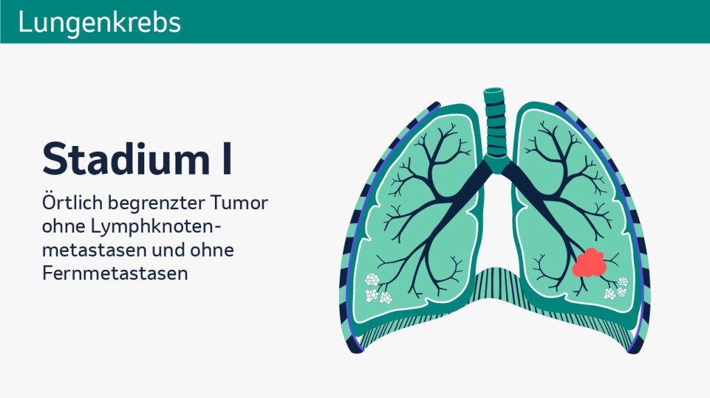 Stadien von Lungekrebs