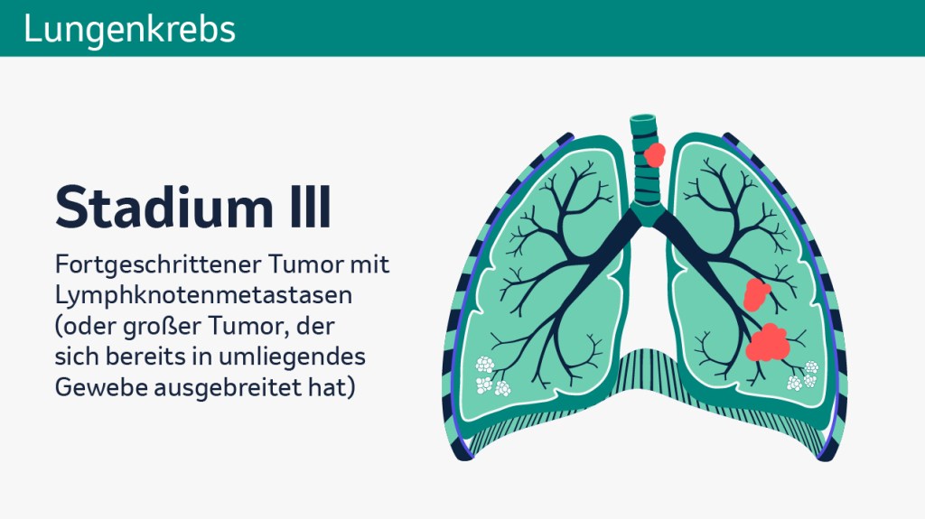 Stadien von Lungekrebs