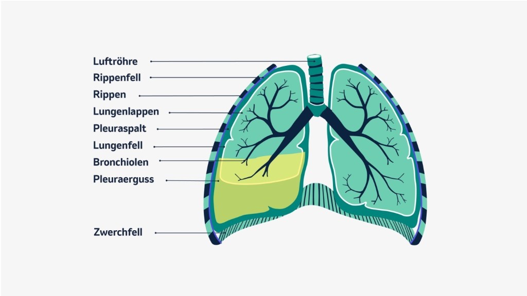 Der Aufbau des Thorax und der Lunge. Im Bild ist ein einseitiger Pleuraerguss zu sehen, zwischen Lungenfell und Brustfell.